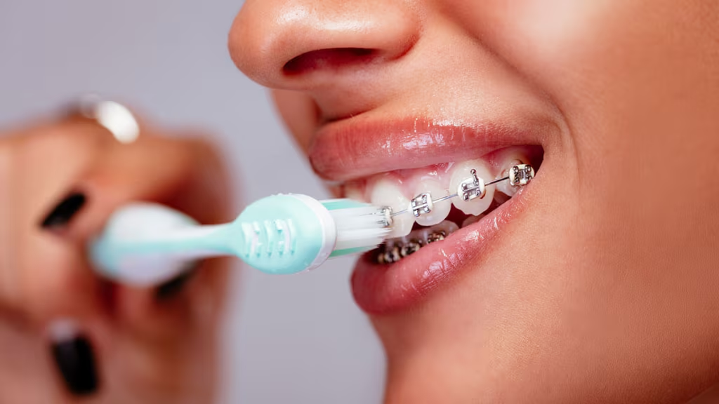 Bàn chải đánh răng: Vai trò trong việc duy trì răng niềng