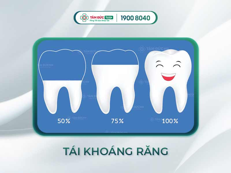 Infographic minh họa quá trình tái khoáng hóa men răng 50% - 75% - 100%