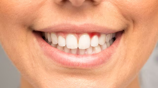 Nướu bị viêm đỏ